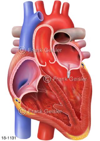 Herz Insuffizienz Herzklappe  Mitralklappe mit MitraClip