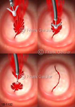 Herz Herzklappen Mitralklappe, Platzierung MitraClip