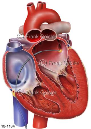 Herz Vorhofflimmern Atrium Herzrhythmusstörung Katheterablation Katheterverödung