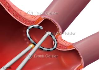 Vorhofflimmern Herz, VHF-Ablation Katheterablation, Behandlung Herzrhythmusstörung