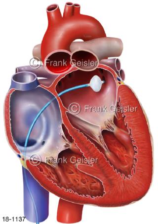Katheterablation, Kryotherapie Kältetherapie