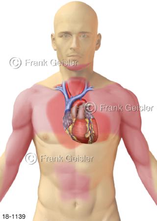 Herzerkrankung Angina pectoris Brustenge Herzbräune