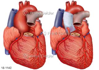 Krankheitsbild Aorta Herz mit Aneurysma Aortenaneurysma, Platzierung Gefäßstütze Stent