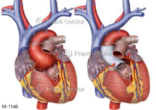 Erkrankung Aorta Herz, Aneurysma Aortenklappe Sinusportion Sinus aortae Valsalvae