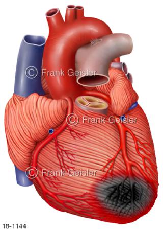 Herzerkrankung Herzinfarkt Herzmuskelinfarkt