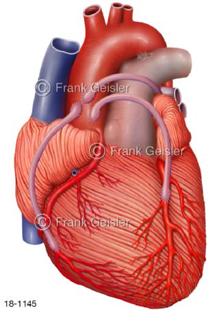 Herzkranzgefäße Herz, Bypass nach OP
