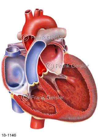 Herzinsuffizienz Herzschwäche Herz