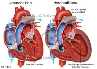 Herzerkrankung Herzinsuffizienz, linker Ventrikel Herz mit Herzschwäche