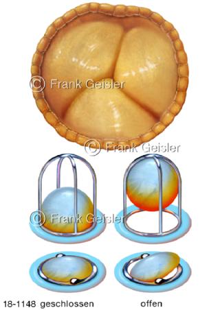 Herzklappe Aortenklappe, künstliche Herzklappen
