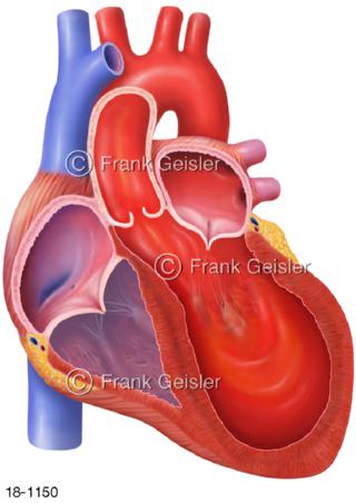 Herz mit Herzerkrankung Takotsubo Stress-Kardiomyopathie