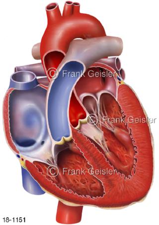 Herzerkrankung Mitralklappe Mitralklappenprolaps Herzsegel