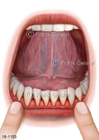 Parodontitis Parodontose Entzündung Zahnfleisch