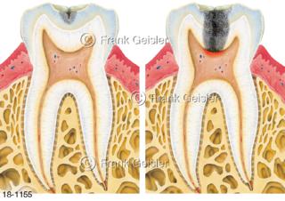 Zahnerkrankung Zahnkaries Schmelzkaries Karies profunda durch Bakterien