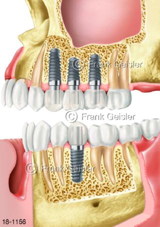 Zahnimplantation Zahnimplantat Zahnwurzel Kiefer