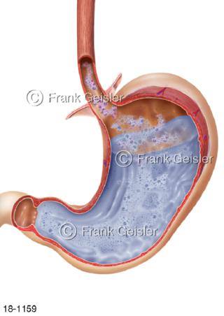 Sodbrennen Reflux in Magen Speiseröhre