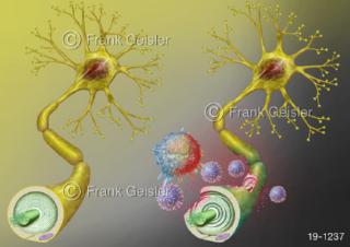 Multiple Sklerose MS autoimmune Erkrankung ZNS, Immunsystem zerstört Schutzhülle Nervenfasern Markscheide