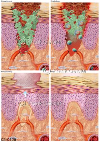 Phasen der Blutgerinnung und Wundheilung