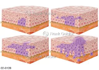 ellgewebe der Schleimhaut Schleimhautepithel mit Krebs-Stadien