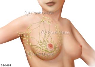 Brust, Lymphgefäße und Lymphknoten der Brustdrüse Mamma