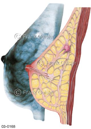 Brust, Brustkrebs Mammakarzinom der Brustdrüse