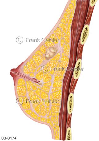 Weibliche Brust, Brustdrüse mit Fibroadenom