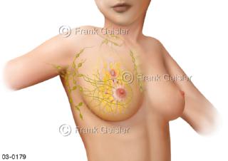 Brustdrüse, Lymphknoten mit Mammakarzinom, Brustkrebs der Frau 