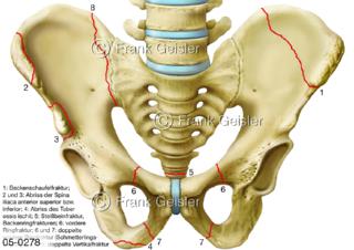 Becken mit Beckenfrakturen Beckenbrüche Frakturen der Knochen