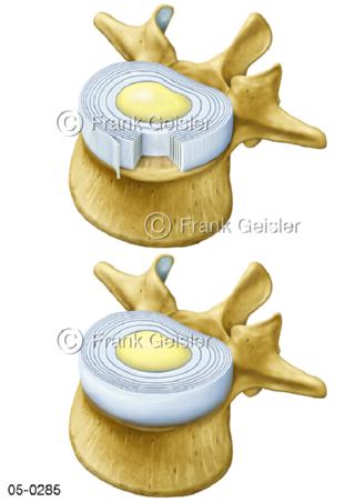 Wirbelkörper mit Bandscheibe Zwischenwirbelscheibe