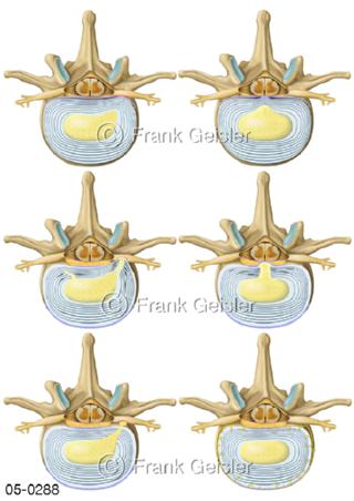 Bandscheibenerkrankungen Bandscheibenprolaps