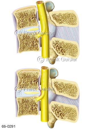 Bandscheibenvorwölbung Lendenwirbel, Lage Rückenmark