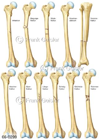 Frakturen Knochen, Knochenbrüche Knochenfrakturen 
