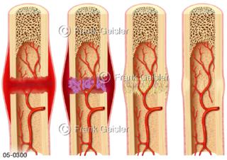 Knochen Knochenbruch Knochenheilung, Phasen der Frakturheilung