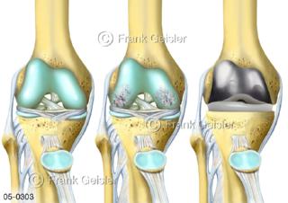 05-0303 Kniegelenk mit Arthrose und TEP Totalendoprothese, künstlicher Gelenkersatz