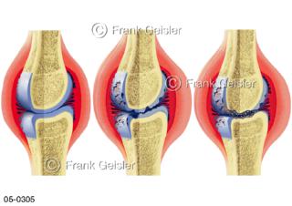 Erkrankungen Gelenk, Gelenkerkrankungen Arthritis Gelenkarthrose Arthrosis deformans