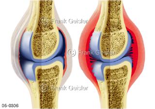 Gelenk, Gelenkrheuma  rheumatoide Arthritis Synovialitis