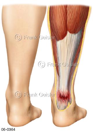 Sehnen Fuß, Ruptur Achillessehne