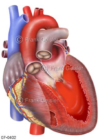Pumpschwäche Herz, kardiogener Schock Herzschock
