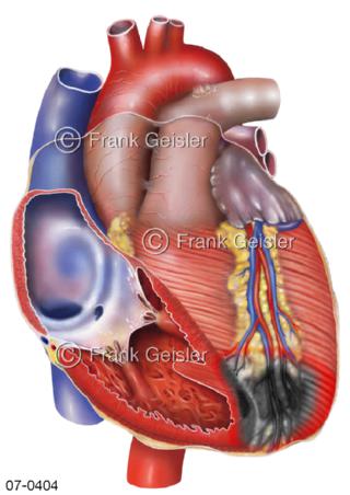 Herzinfarkt Myokardinfarkt, Verschluss Koronararterie