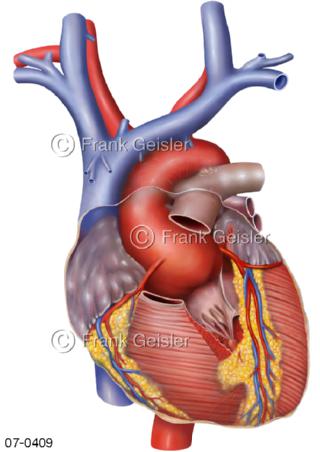 Herz Aortenklappe Aneurysma Sinusportion