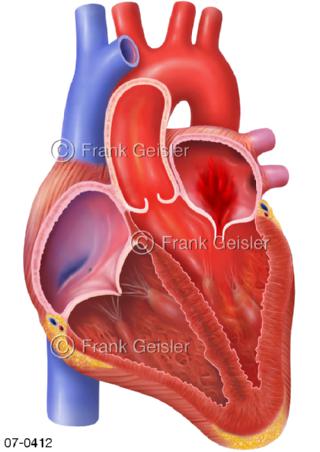 Herz, Herzfehler Mitralklappe, Mitralinsuffizienz