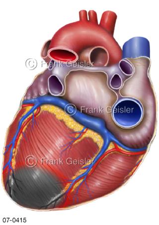 Herz, Herzinfarkt Myokardinfarkt Hinterwandinfarkt