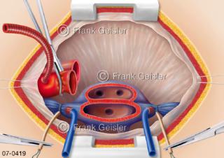 Herztransplantation Transplantation Herz-OP 1