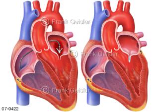 Herz, Herzklappe bei Mitralinsuffizienz, Platzierung Mitraclip