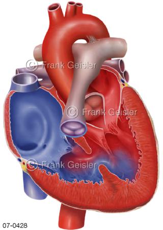 Herz. Herzfehler Fallot-Tetralogie