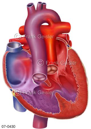 Herz, Herzfehler Transportation große Arterien TGA