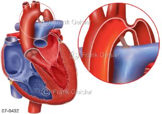 Herzfehler, Postduktale Aortenisthmusstenose ISTA, Verengung der Aorta