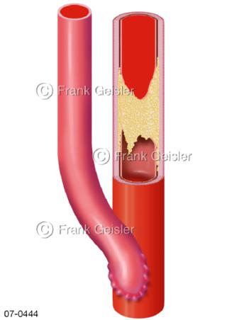 Blutgefäße, Bypass bei Arteriosklerose