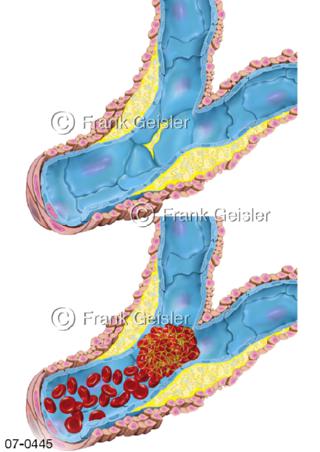 Blutgefäße, Arteriosklerose durch Plaque