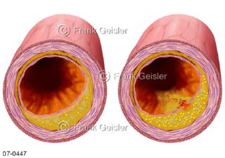 Arterien mit Arteriosklerose, stabile und instabile Plaque in der Gefäßwand