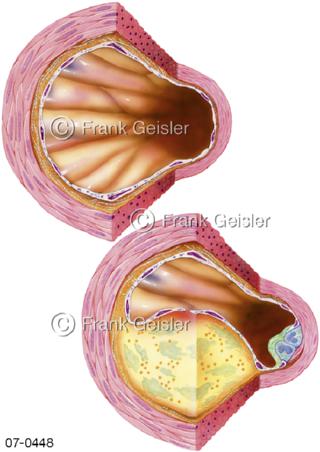 Arterien, Gefäßwand ohne und mit Arteriosklerose